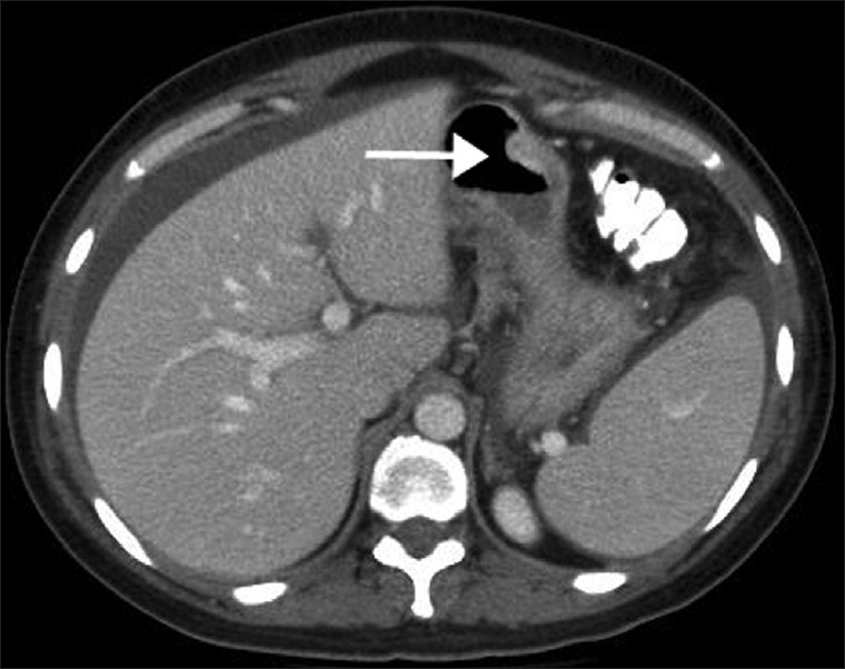 Contrast-enhanced axial CT at the level of the liver reveals a focal nodular thickening of the gastric body along the greater curvature and antrum (arrow) suggestive of gastric carcinoma that was subsequently confirmed by histopathology.