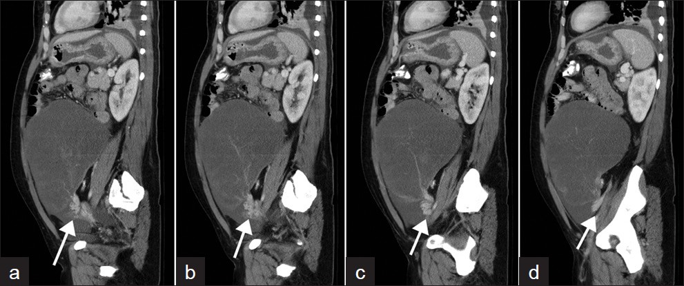 Four contiguous sagittal images showing a discrete ‘swirl sign’ at the vascular pedicle (white arrows) at the base of the large left ovarian mass, consistent with the torsion of ovarian Krukenberg tumor at its pedicle.