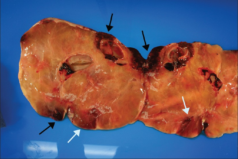 A gross image of bi-valved left ovary weighing 2475 g and measuring 26 × 21 × 6 cm. Note the large hemorrhagic area on one end of the ovary (white arrow), measuring 11 × 5 × 2.5 cm, and other smaller areas of hemorrhage within the solid ovarian mass. The black arrows depict areas of infarction. (The deceptive cystic appearance on CT was due to a poor flow, with large areas of infarction).