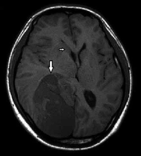 TI weighted image of the 19-year-old male with dysembryoplastic neuroepithelial tumor involving the right temporo-oocipital lobe (large arrow) and mass effect at the anterior horn of right lateral ventricle (small arrow).