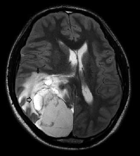 T2 weighted axial image at the level of head of caudate nucleus shows the peritumoral edema (small arrow) multinodular lesion in the temporooccipital lobe (large arrow).