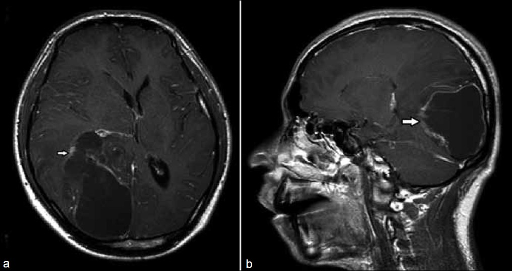 (a) Gd contrast enhanced T1 weighted axial image at the level of caudate nucleus shows the lesion wall enhancement (arrow). (b) Corresponding sagittal plane lesion involving temporo-occipital lobe reconfirms the axial plane features