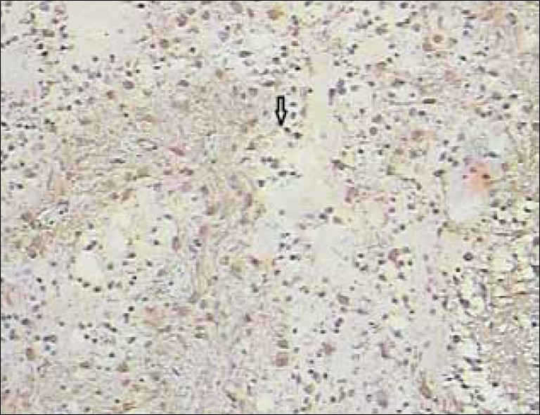 Glial Fibrillary Acidic Protein (GFAP) stained histopatholgy slide shows the specific glioneuronal elements (arrow). Immunohistochemistry for glial fibrillary acidic protein (GFAP), S-100 protein, establish the presence of astrocytic and neuronal components, while GFAP reactivity is negative for an oligodendrocytic component