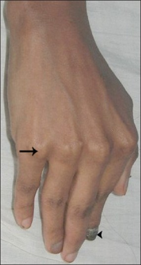 Right-hand shows flexion contractures of the fingers (arrow) and dysmorphic nail (arrowhead).