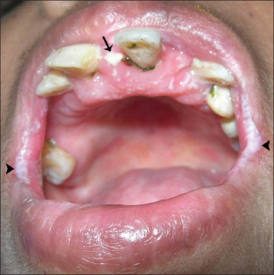 Intra-oral view of the mucosa shows scrappable curdy white patches (arrow). positive for fungal hyphae and angular cheilitis (arrowhead).