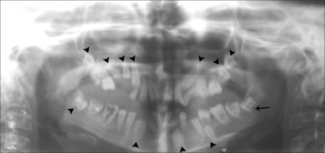 Orthopantomograph shows multiple impacted permanent teeth (arrow head) with delayed eruption and incomplete root formation (arrow).