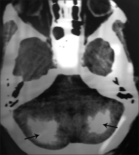 Axial CT of brain shows diffuse, symmetric parenchymal calcifications in the cerebellar region (arrow).