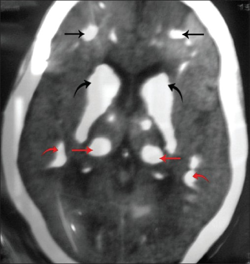 Axial CT of brain shows extensive symmetric calcifications in the frontal lobe (black straight arrow), periventricular region (black curved arrow), basal ganglia (red straight arrow), and parietal lobe (red curved arrow).