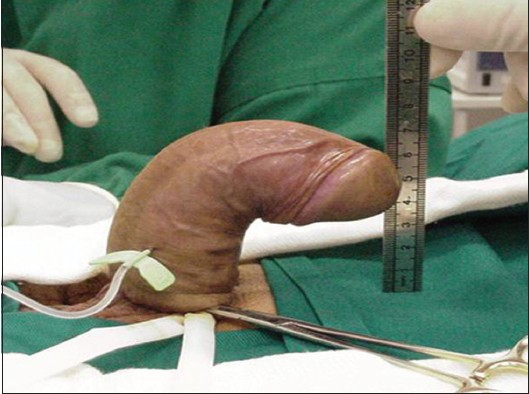 Penile curvature due to Peyronie's disease. A 47-year-old man with excessive dorsal penile curvature at the middle of the penile shaft. The image shows the deformity after artificial erection prior to reconstructive operation