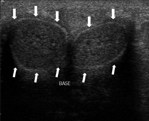 US imaging of a normal penis in transverse view of a 55-year-old man. The corpora cavernosa appear as homogenous cylindrical structures. The tunica albuginea and Buck fascia are stuck together and appear as a thin echogenic line surrounding the corpora (white arrows).