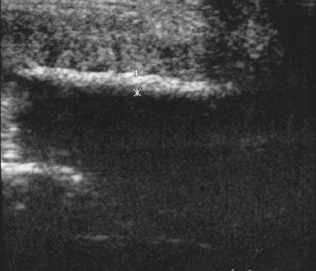 Penile plaques due to Peyronie's disease. A 39-year-old man with palpable mass at dorsal-right area of the penile shaft. Longitudinal sonogram demonstrates the length of the plaque. The thickness of the lesion (1.2 mm) is measured by the crosses