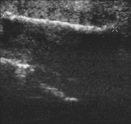 Large calcified penile plaques with acoustic shadow due to Peyronie's disease (Same patient shown in Figure 3). Longitudinal sonogram evaluates the length of the plaque, by the large crosses (4.2 cm).