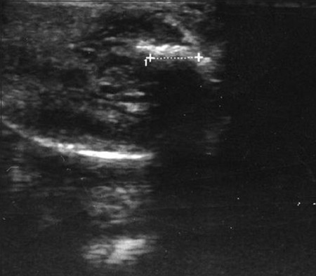 Small echogenic Peyronie's plaque. A 43-year-old man suffering from lateral curvature. The scan shows the length of the plaque as defined by the crosses (1.2 cm).