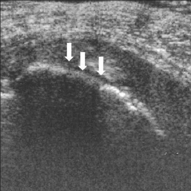 Hypoechoic lesion of the tunica albuginea. A 61-year-old man with left-dorsal curvature and painful erection. The scan shows hypoechoic lesion marked by white arrows