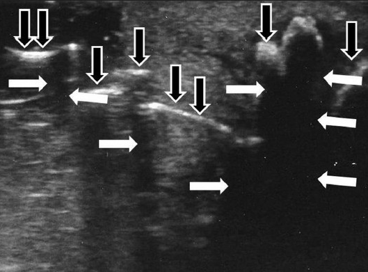 A 49-year-old man with Peyronie's disease presenting with hourglass deformity. The scan shows acoustic shadows produced by the calcifications (white arrows) and multiple calcifications of the tunica albuginea (black arrows).