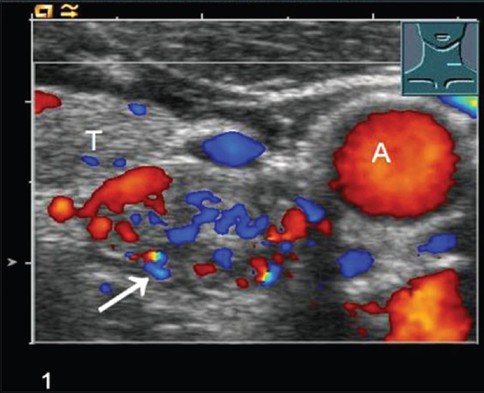 Color-coded Doppler ultrasonography shows a parathyroid adenoma (arrow), Thyroid lobe (T), Carotid artery (A).