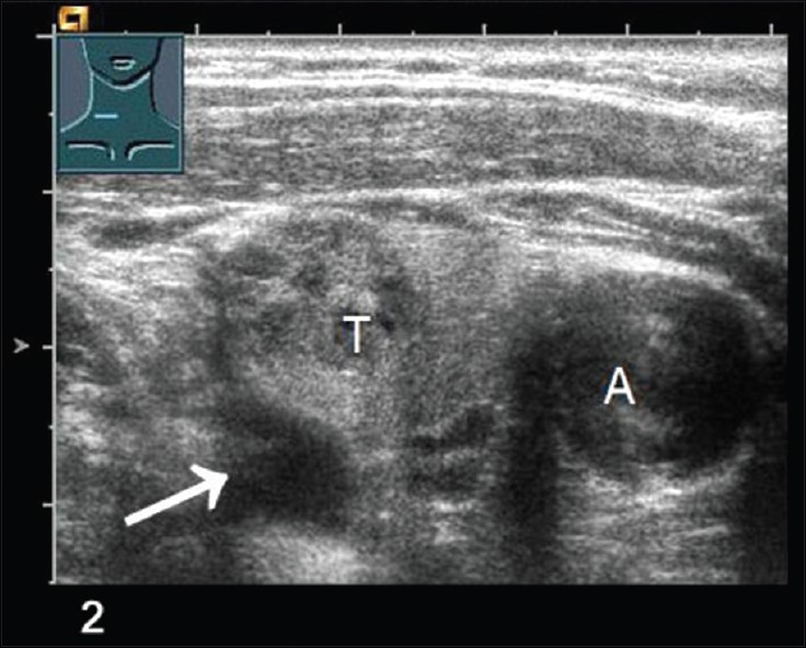Conventional B-mode US scan shows a parathyroid adenoma (arrow), Thyroid lobe (T), Carotid artery (A).