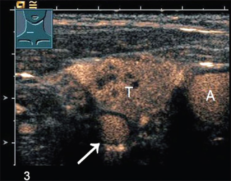 Contrast-enhanced ultrasonography CEUS in wash-in phase shows a parathyroid adenoma (arrow), Thyroid lobe (T), Carotid artery (A).