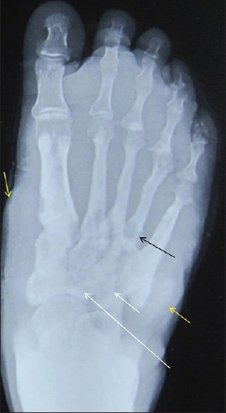 Chronic osteomyelitis. A 48-year-old man with painless swelling of left foot. Frontal radiograph shows moth eaten area of destruction involving tarsal (white arrow) and metatarsals (black arrow) with patchy erosions and mild soft tissue swelling (yellow arrow).