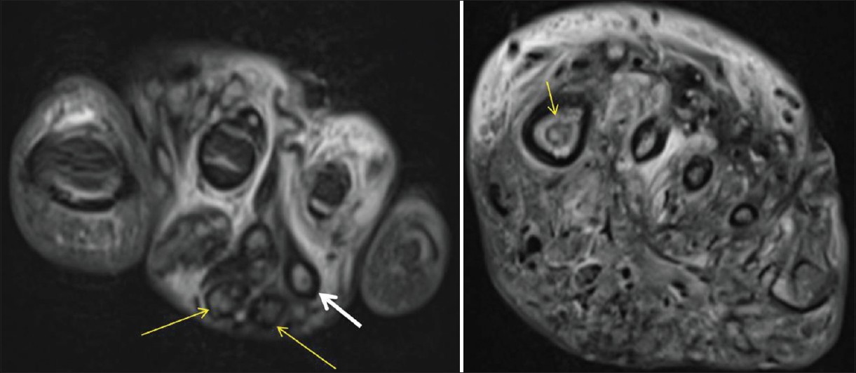 MRI T2 weighted coronal images show inflammatory changes with multiple soft tissue and osseus small hyperintense lesions with peripheral hypointense rim corresponding to mycetoma grains (yellow arrows). Few of them showing “dot in circle” sign (thicker white arrow).