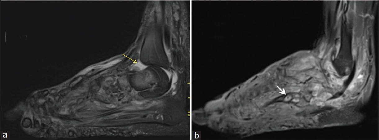 (a) T2 weighted fat suppressed sagittal and (b) T1W fat suppressed postcontrast sagittal images show extension of inflammation proximally up to distal leg with ankle joint effusion (yellow arrow) and synovial thickening. “Dot in circle” sign (white arrow) is seen in postcontrast image.