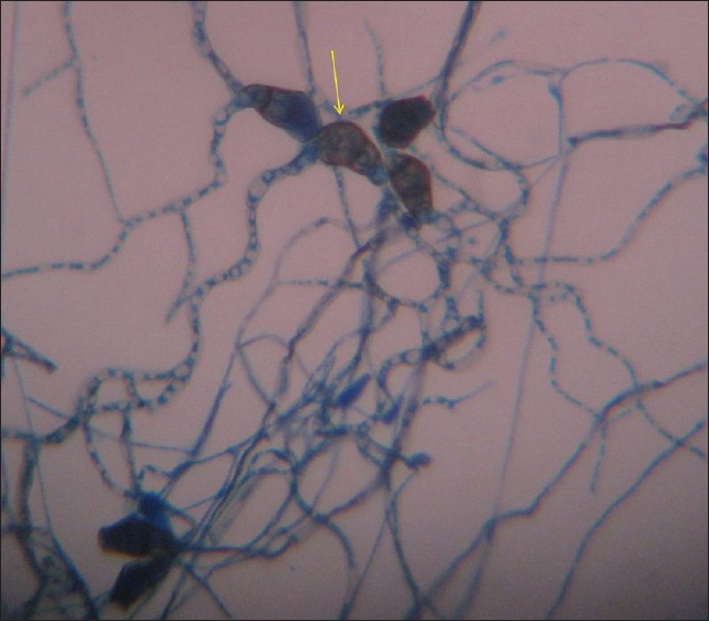 Histopathology slide prepared using lactophenol cotton blue shows septated conidia which is curved at 3rd cell from the base (yellow arrow) confirming the diagnosis of curvularia lunata (eumycetoma sp.) ×1500.