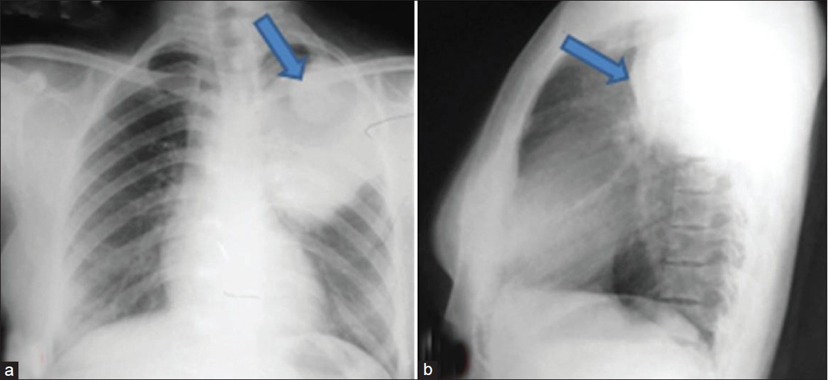 Chest X-ray (a) posterior anterior (PA) and (b) lateral views show well-defined homogeneous soft tissue opacity within posterior mediastinum, causing erosion of the 4th rib posteriorly, scalloping of the superior margin of the 5th rib and widening of the 4th intercostal space (arrow).