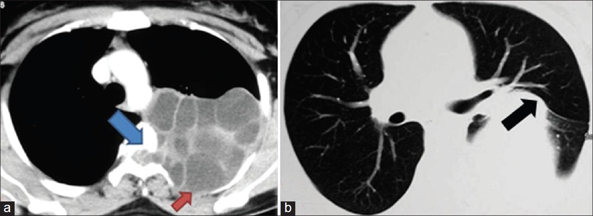 Contrast enhanced computed tomography (CT) thorax in (a) mediastinal and (b) lung windows show multiloculated cystic lesion in left paravertebral space, causing erosion of pedicle and lamina of the 4th dorsal vertebra, with intraspinal extension (blue arrow). The 4th rib is eroded (red arrow). Lung parenchyma is extrinsically compressed, unremarkable otherwise (black arrow).