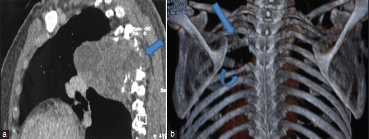 (a) Three dimensional sagittal multiplanar reformation shows posterior mediastinal mass causing destruction of adjoining vertebra (arrow) with intraspinal extension. (b) Volume rendered coronal image shows erosion of the 4th rib (straight arrow) and scalloping of the 5th rib (curved arrow) with widened 4th intercostal space.