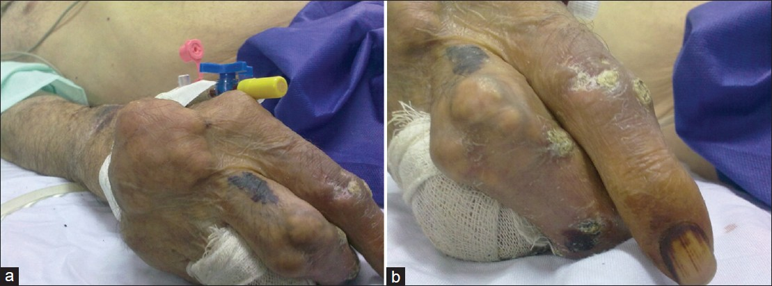 (a and b) Multiple nodules overlying deformed joints seen in the hand of a chronic patient with tophaceous gout.