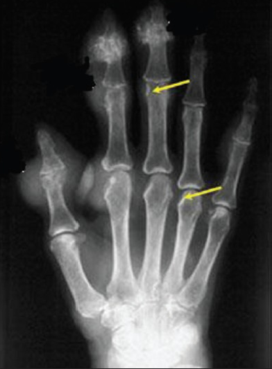 Soft tissue radiograph of hand shows swelling and arrows point to bone erosion.