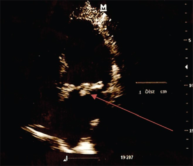 Transthoracic echocardiogram in apical 4 chamber view: Arrow points to a hyperechoic, oval-shaped mass on the mitral valve.