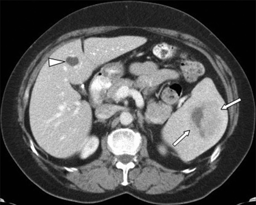 Contrast-enhanced axial computed tomogram (CT) image obtained during portal venous phase shows a large mass (arrows) in the spleen, the mass is showing diffuse homogeneous enhancement on the lateral aspect and the medial aspect is hypoenhanced. A cyst in the liver is also demonstrated (arrowhead).