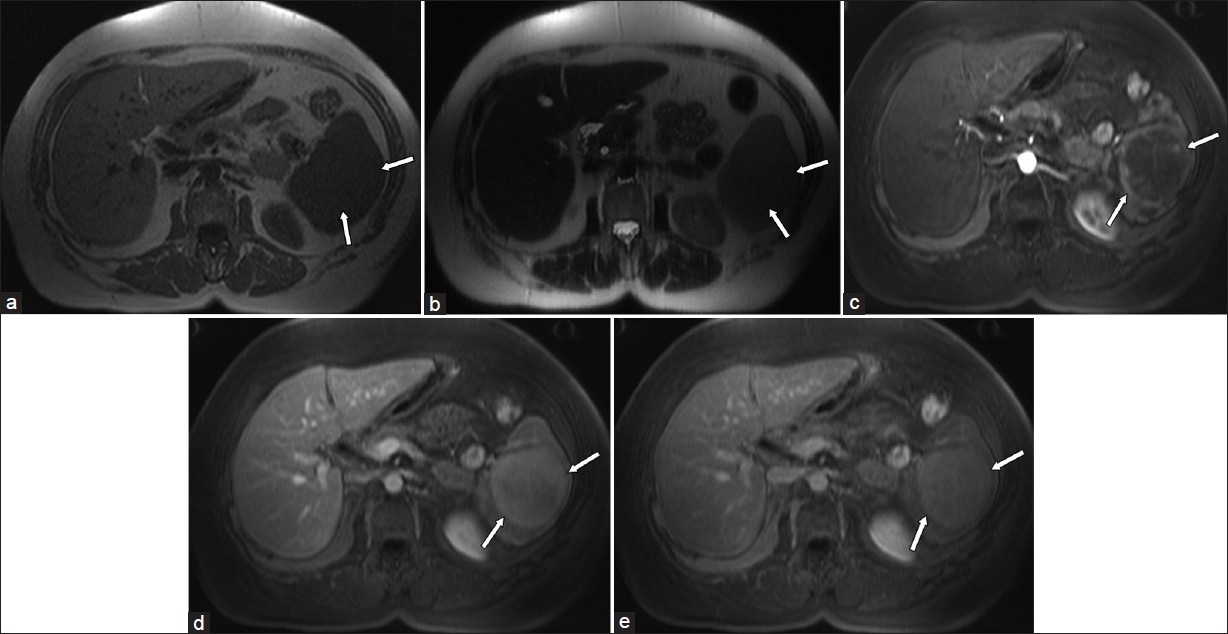 Axial magnetic resonance imaging (MRI) images at the level of mid spleen show a large mass (arrows) which is isointense to the rest of splenic parenchyma before contrast injection on (a) T1-weighted and (b) T2-weighted images. (c) It shows peripheral nodular and internal septal enhancement during arterial phase on T1-weighted fat suppressed pulse sequence. (d) Diffuse enhancement during portal venous phase and (e) remains enhanced on delayed 3-min image.