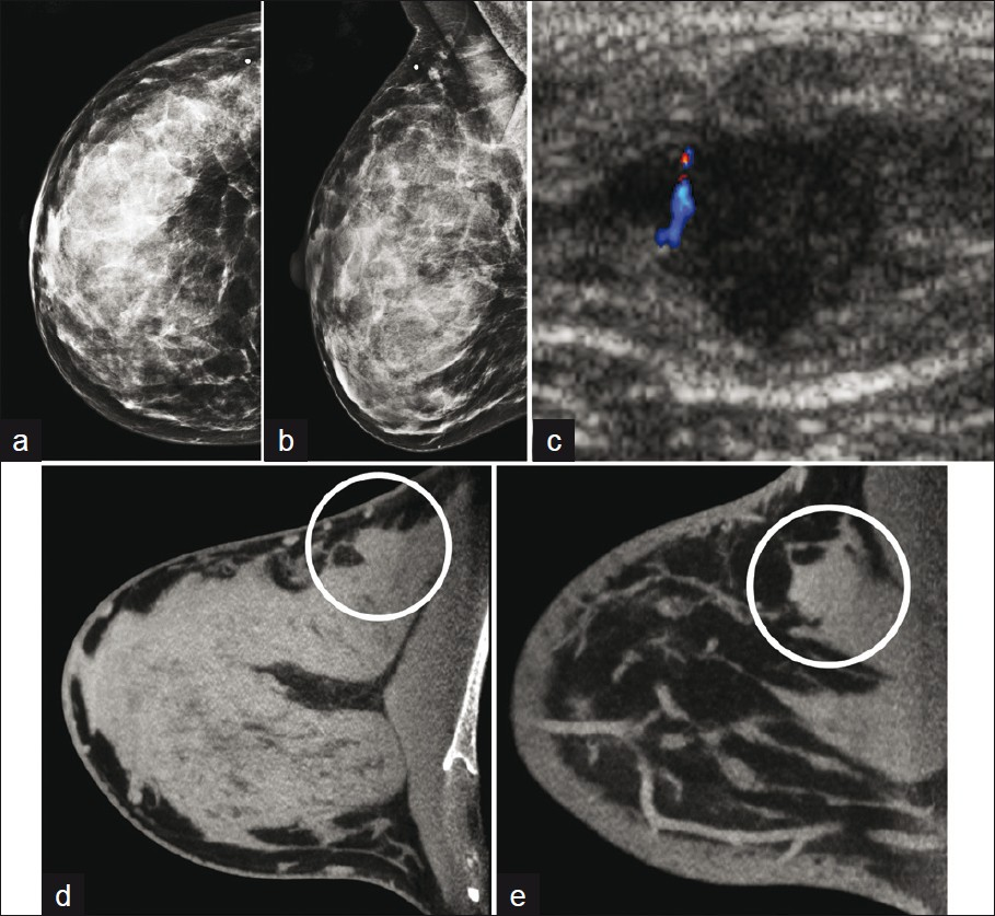 A forty-two-year-old woman with palpable lump in upper outer breast. No abnormality was present on mammographical (a) R CC (b) R MLO views (c) biopsy of sonographical mass demonstrated invasive ductal carcinoma. CBBCT demonstrates mass with convex margins arising from glandular tissue in the posterior lateral breast/axilla in both (d) transverse (e) sagittal 1-mm thick sections, which approximate CC and MLO views, respectively.