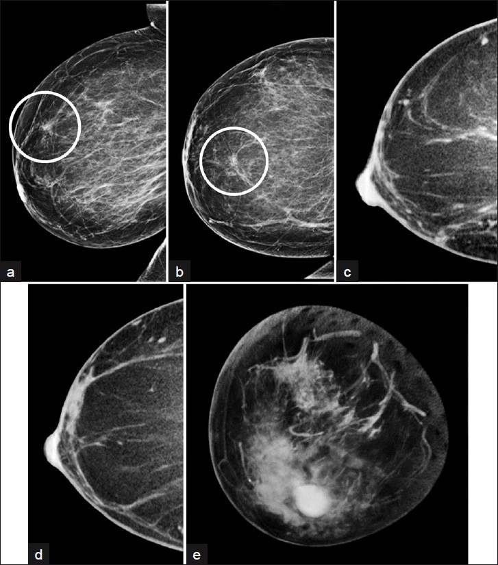 A fifty-two-year-old woman with developing focal asymmetry in screening mammography. (a) R ML (b)RCC mammographical views of focal asymmetry in 12 o’clock position in the anterior 1/3 of the right breast, which persisted in spot compression views (not shown). CBBCT (c) sagittal (d) transverse views in the expected location do not demonstrate any suspicious lesion. (e) Volume-rendered CBBT image demonstrates no evidence of mammographical lesion in the anterior breast. Stereotactic biopsy demonstrated benign histology (“fibrocystic changes”).