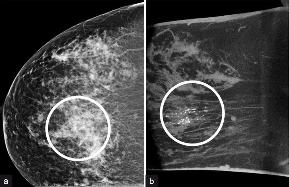 A fifty-five-year-old woman with microcalcifications in screening mammogram. (a) Diagnostic RCC demonstrates clusters of microcalcifications within overlapping glandular tissue. Despite small size, these calcifications are more conspicuous in (b) volume-rendered images at standard 0.27-mm3 resolution. Stereotactic biopsy demonstrated DCIS.