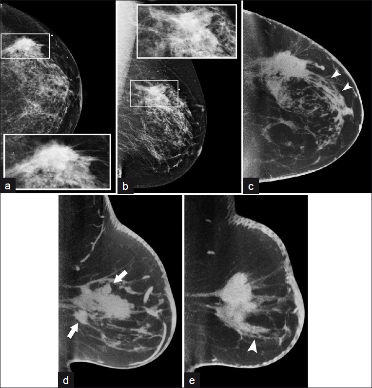 A fifty-eight-year-old woman with mammographical mass in the posterior breast. Diagnostic (a) L CC (b) MLO views with detail of region of interest (inset); CBBCT images in (c) transverse and sagittal (through the d) medial and (e) lateral portions of the lesion, respectively) 3.0-mm sections demonstrate spicules extending from the mass anteriorly (arrowheads, c and e) and additional possible satellite nodules (arrows, d).