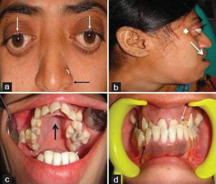 Patient photograph shows (a) hypertelorism (white arrow), parrot beak nose (black arrow). (b) Profile view shows hypoplastic maxilla (white arrow) leading prognathism of mandible (black arrow) and exophthalmos (smallwhitearrow). (c) Intra oral view shows high arch palate (black arrow). (d) Front view of the teeth reveal hypoplastic maxilla (white arrow) and class III malocclusion (black arrow).