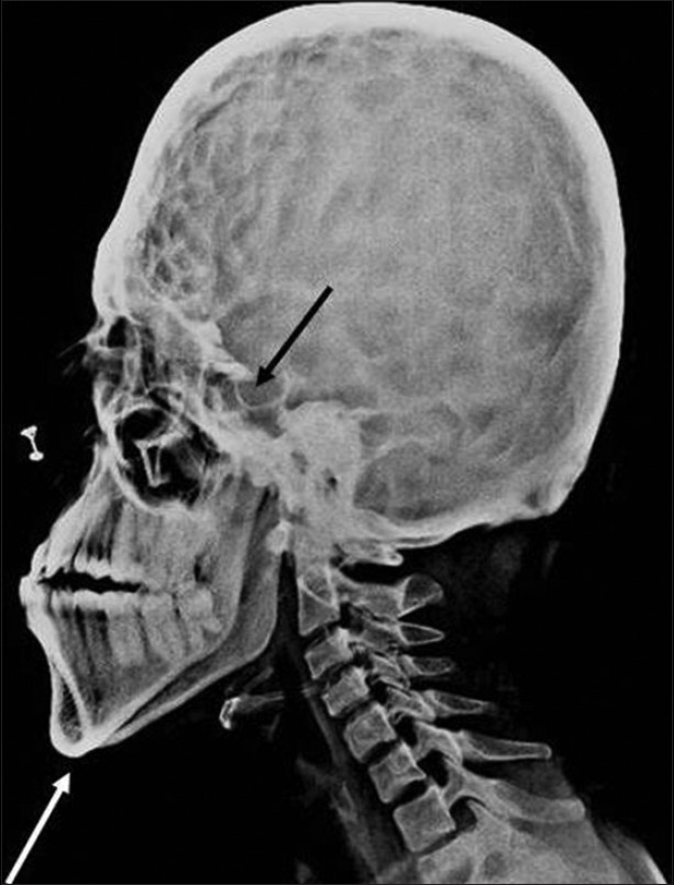 Lateral skull projection reveals mandibular prognathism (white arrow), maxillary hypoplasia, copper beaten appearance, and enlarged hypophyseal cavity (black arrow).