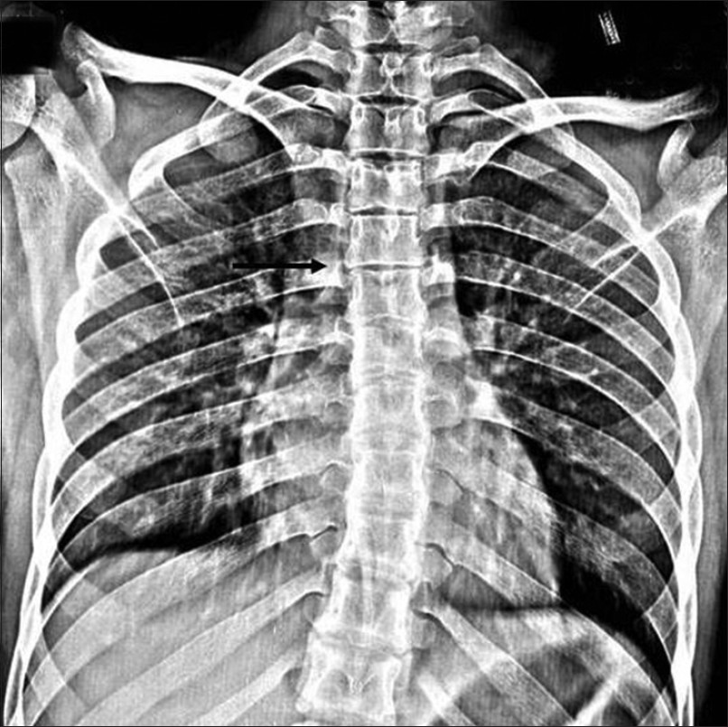 Anteroposterior spine radiograph shows decreased intervertebral space between C5 and C6 (black arrow).