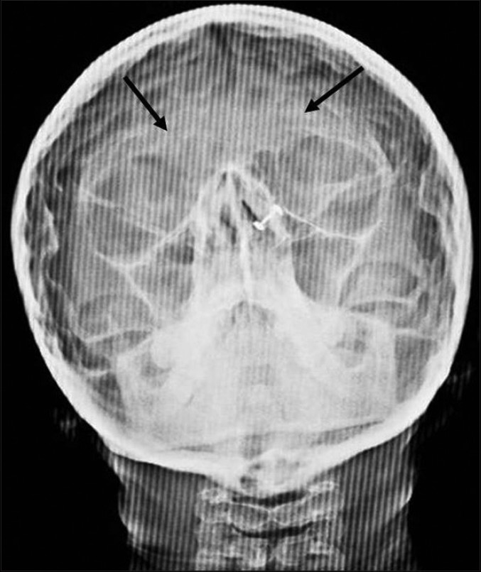 Paranasal sinus view shows prominent convolution markings suggestive of copper beaten appearance (black arrow).