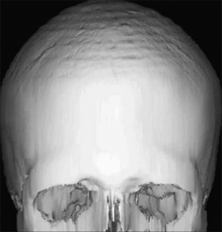 Three-dimensional (3D) computed tomographic images of skull show increased circumference of the skull