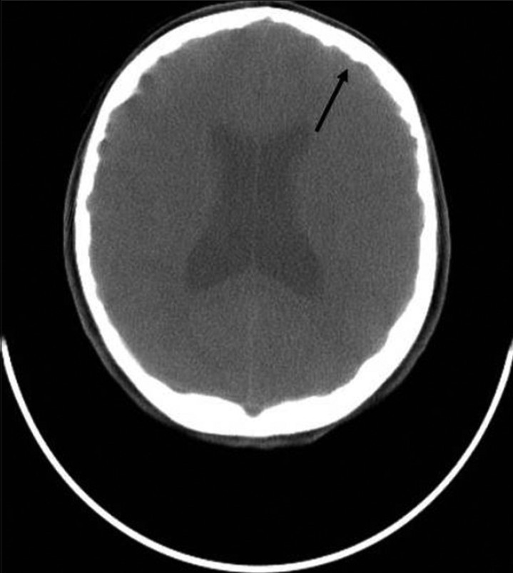 Computed tomography (CT) image of the skull shows moderate degree of hydrocephalus with diffuse indentation of inner table of skull (black arrow).