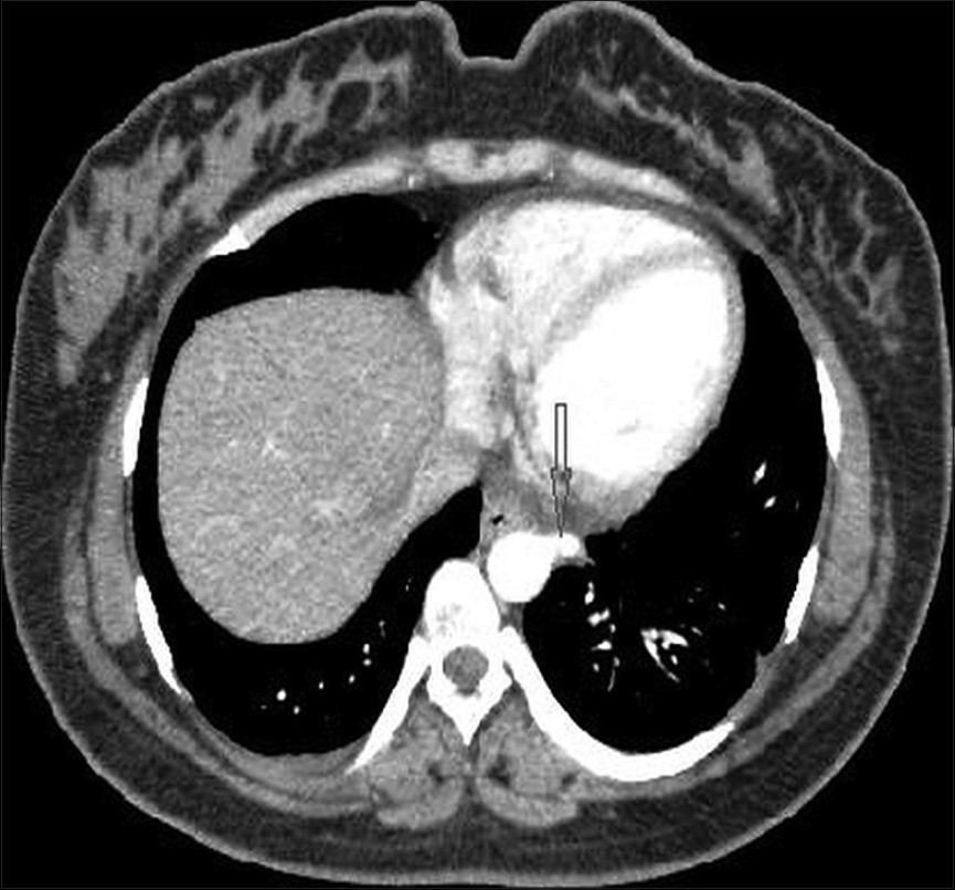 Intralobar pulmonary sequestration. A 26-year-old woman with recurrent hemoptysis. Contrast-enhanced spiral computed tomography (CT) shows the aberrant artery (arrow) originated from thoracic aorta and introduced to lower left lobe of the lung.