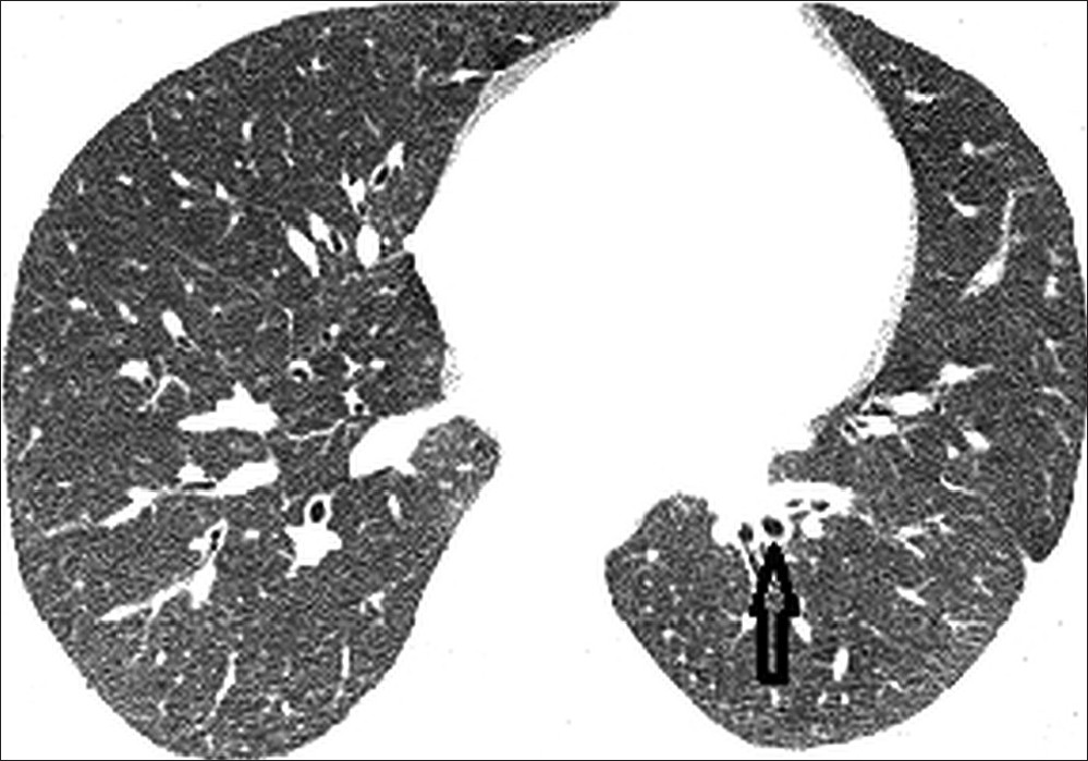 Computed tomography image of the lung shows small intralobar sequestrated area as bronchiectasis (arrow) in the left lower lobe (LLL).