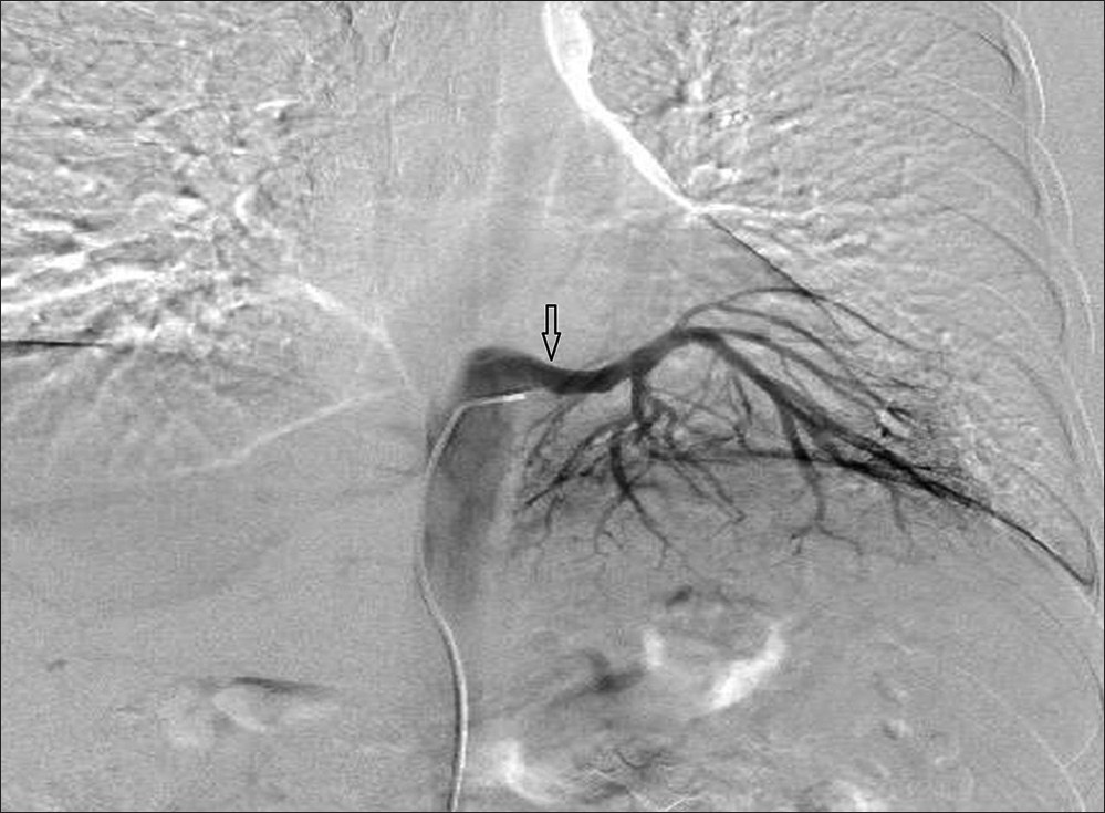 Aortography image reveals the aberrant arteries (arrow). The anomalous artery originates from the distal part of the thoracic aorta and supplies the blood circulation of the sequestrated lung tissue.