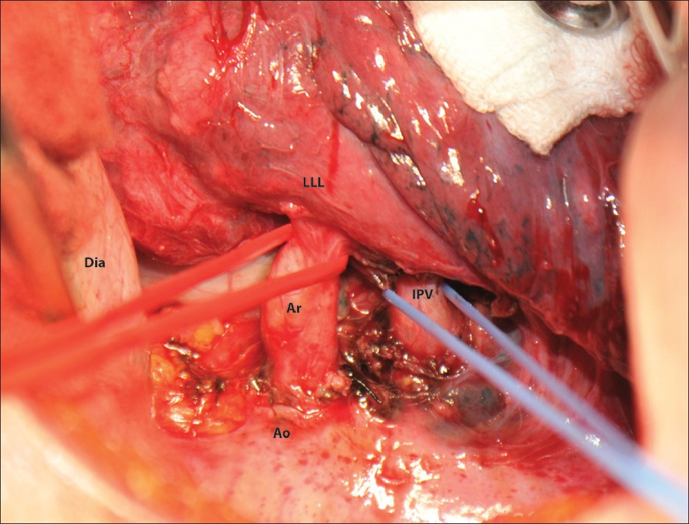 Operative view of the patient. Dia: Diaphragm, Ao: Aorta, Ar: Aberrant artery, IPV: Inferior pulmonary vein, LLL: Left lower lobe.