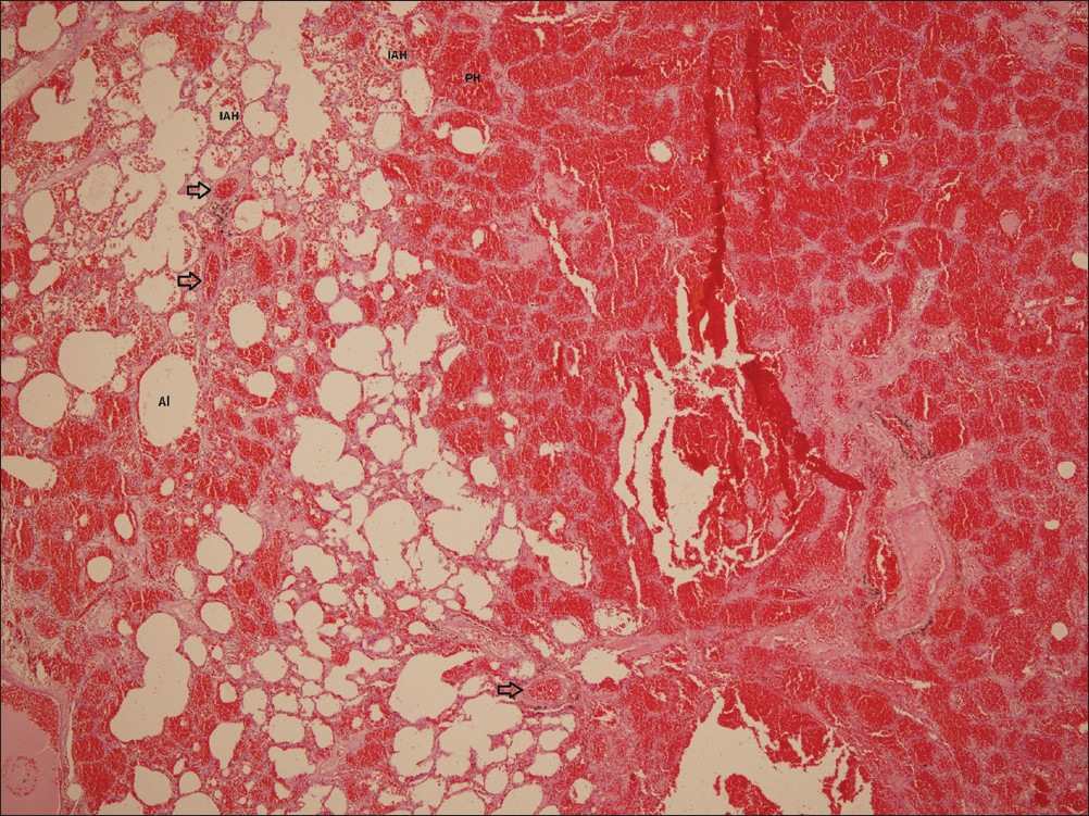 H and E, ×40 magnification of the specimen reveals intra-alveolar hemorrhages (IAH), parenchymal hemorrhages (PH), and vascular congestions (arrow). Al: Alveolus.