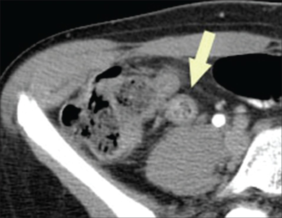 Mucocele of the appendix. Axial computed tomography image through the pelvis shows an enlarged tubular structure in the right lower quadrant without significant adjacent inflammatory change (arrow). Note the bubbly appearance of the luminal contents.